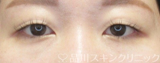 症例NO.69429のBEFORE写真