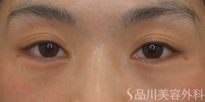 症例NO.74620のAFTER写真