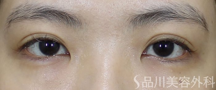 症例NO.72094のAFTER写真