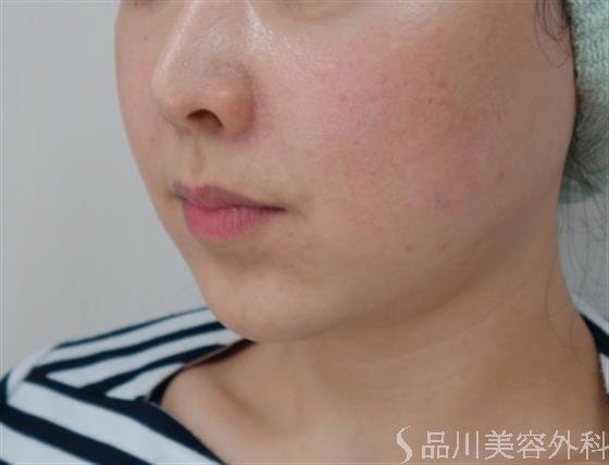 症例NO.33289のBEFORE写真