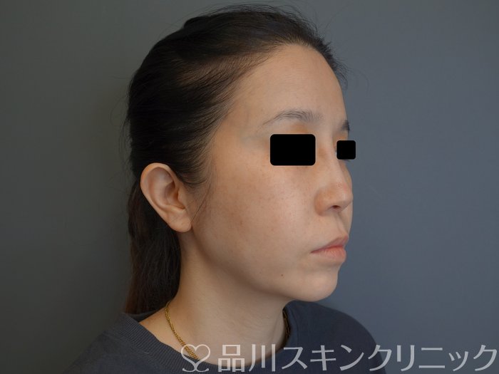 症例NO.75051のBEFORE写真