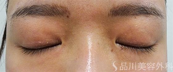 症例NO.54017のBEFORE写真