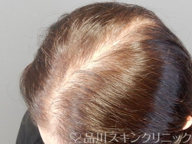 症例NO.69316のBEFORE写真