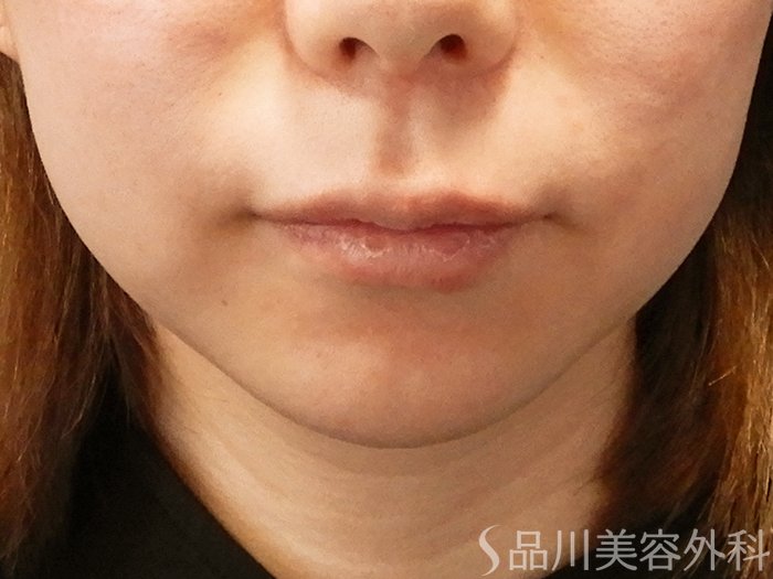 症例NO.70058のAFTER写真