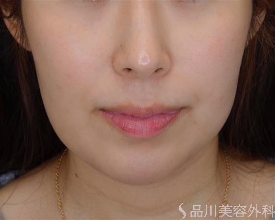 症例NO.50855のBEFORE写真
