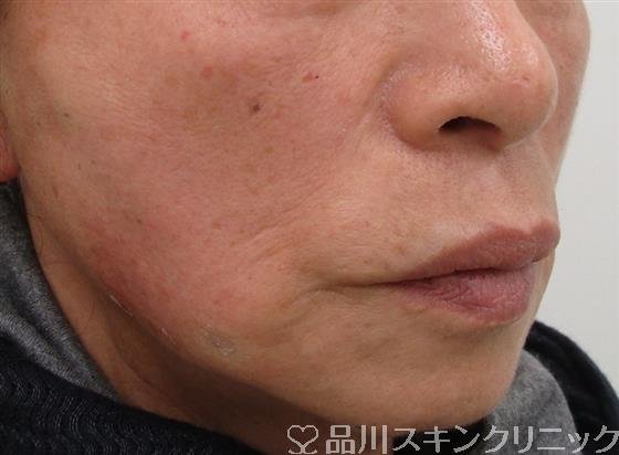 症例NO.40314のAFTER写真
