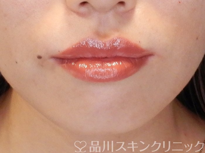 症例NO.65348のAFTER写真