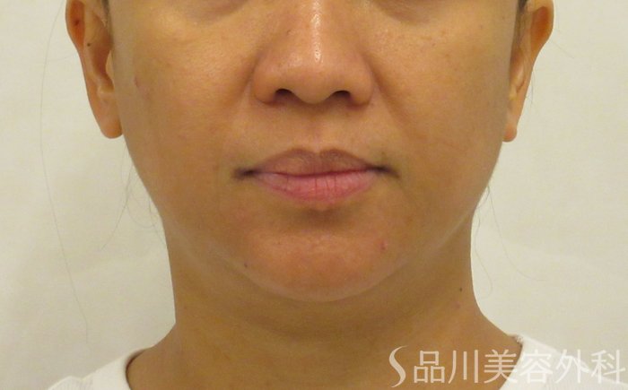 症例NO.72460のBEFORE写真