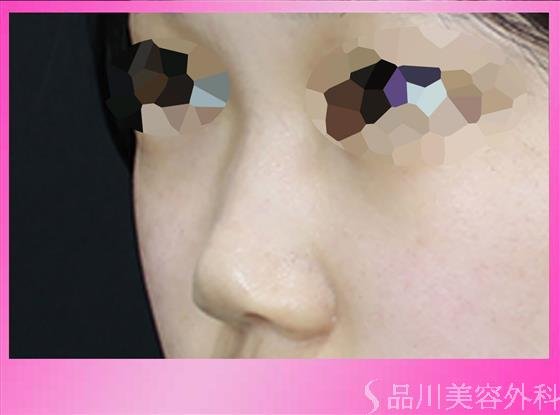 症例NO.49190のBEFORE写真