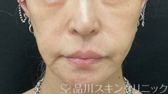 症例NO.74504のBEFORE写真