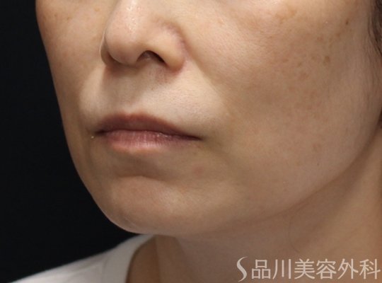 症例NO.74731のBEFORE写真