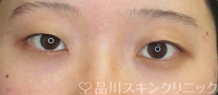 症例NO.73747のBEFORE写真