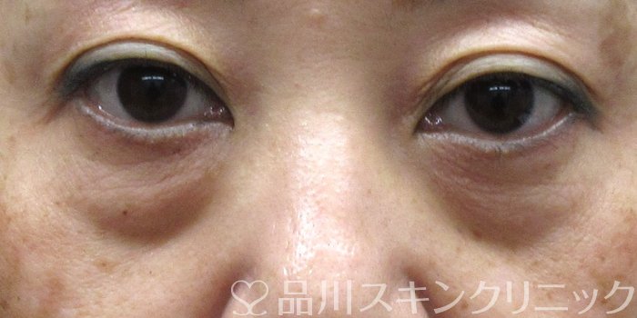 症例NO.74409のBEFORE写真