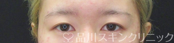 症例NO.63386のBEFORE写真