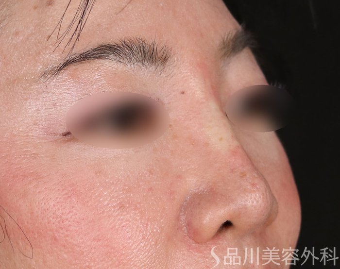 症例NO.74108のAFTER写真