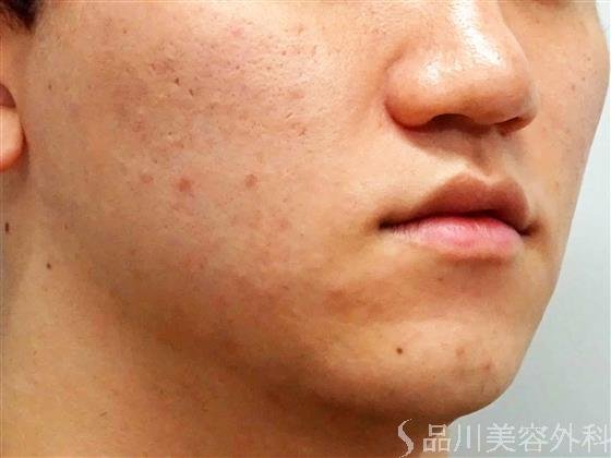 症例NO.56668のBEFORE写真