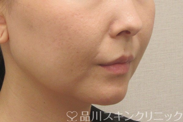 症例NO.72405のBEFORE写真