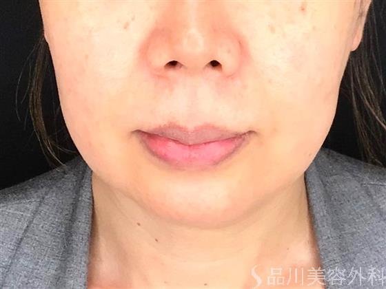 症例NO.61952のBEFORE写真