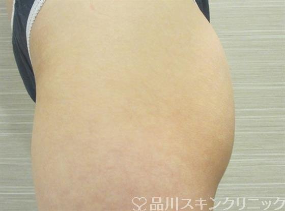 症例NO.36296のBEFORE写真