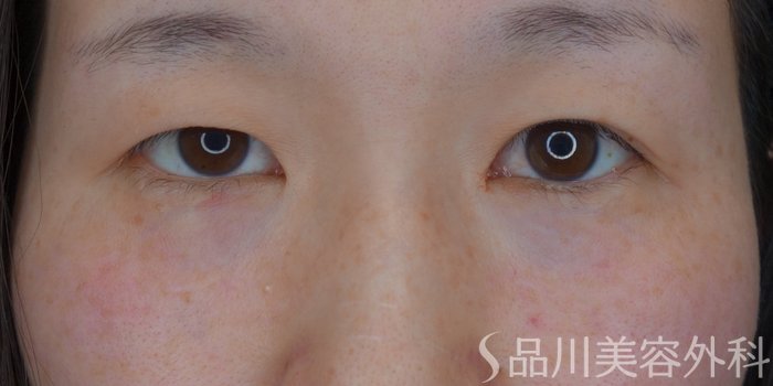 症例NO.74419のAFTER写真