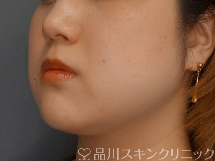 症例NO.74129のBEFORE写真