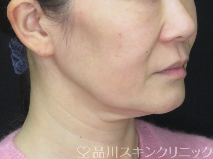 症例NO.73832のBEFORE写真