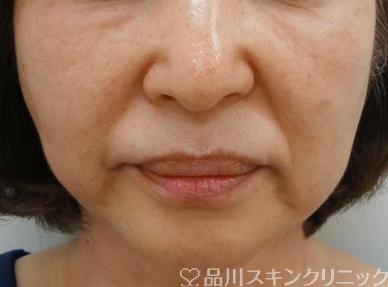 症例NO.29688のBEFORE写真