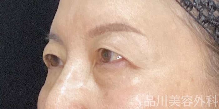 症例NO.72562のBEFORE写真