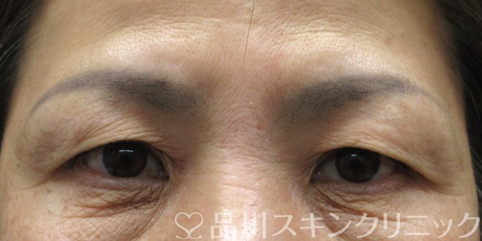 症例NO.70559のBEFORE写真