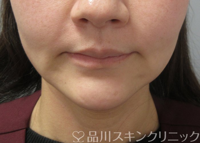 症例NO.75193のAFTER写真