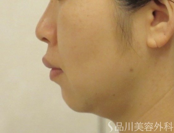 症例NO.74074のBEFORE写真