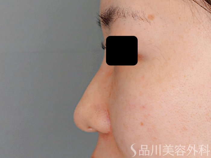 症例NO.70609のBEFORE写真