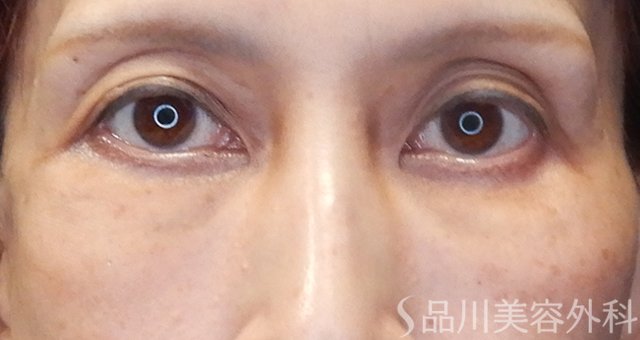 症例NO.67975のAFTER写真