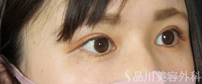 症例NO.69581のAFTER写真