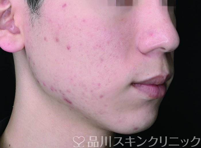 症例NO.65510のBEFORE写真