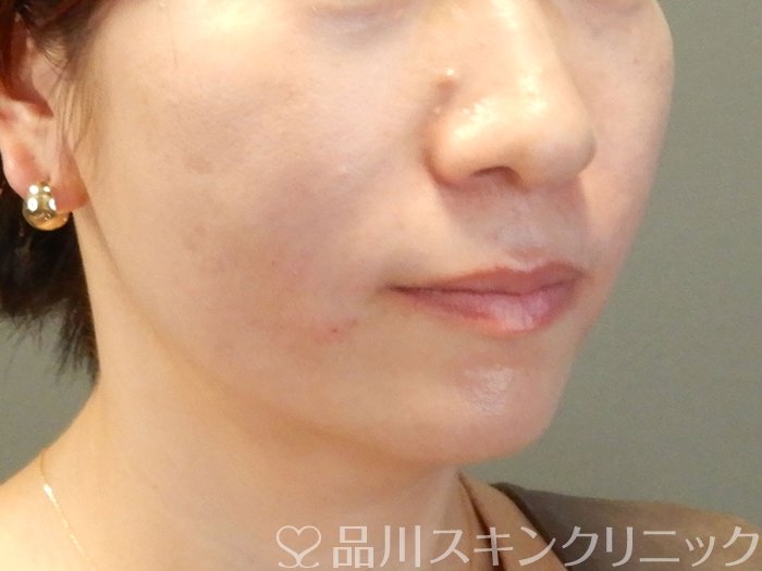 症例NO.62408のAFTER写真