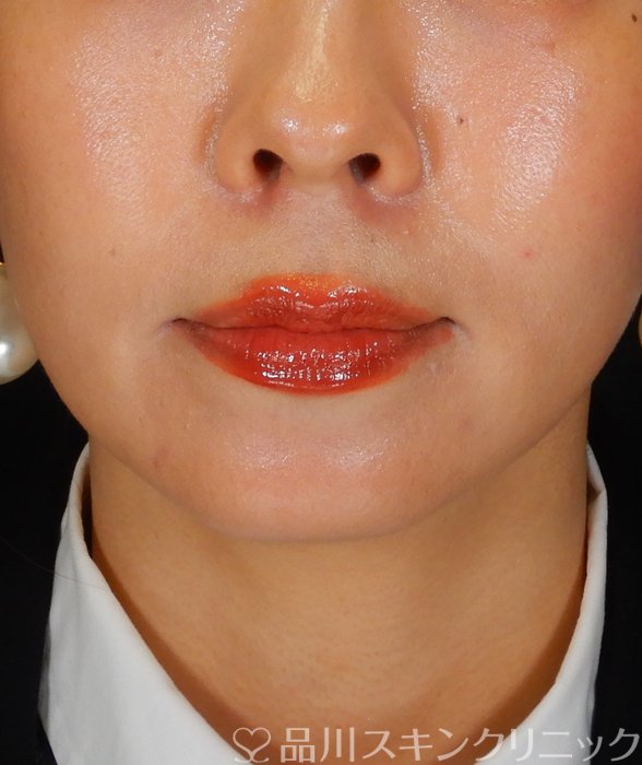 症例NO.66958のBEFORE写真