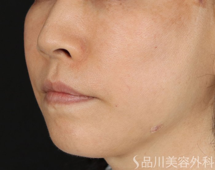 症例NO.71219のAFTER写真