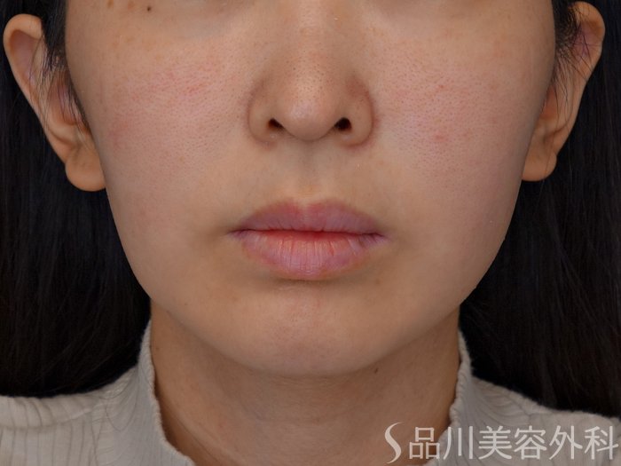 症例NO.74151のBEFORE写真