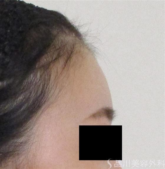 症例NO.59193のAFTER写真