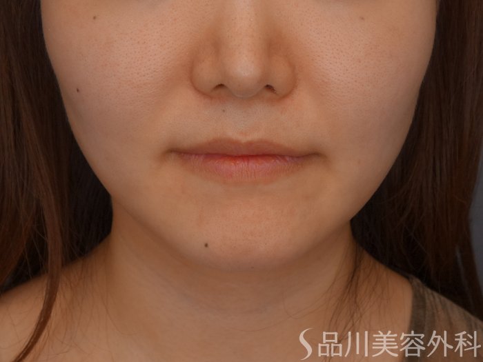 症例NO.72434のBEFORE写真