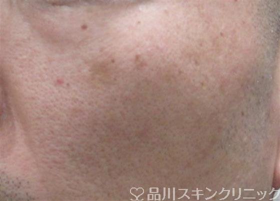 症例NO.33662のBEFORE写真