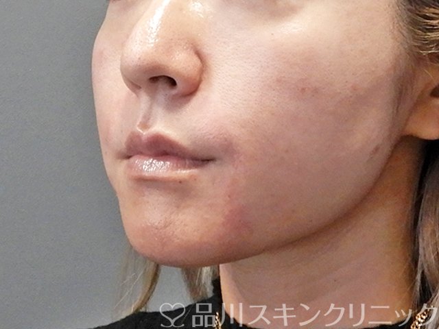 症例NO.68506のAFTER写真