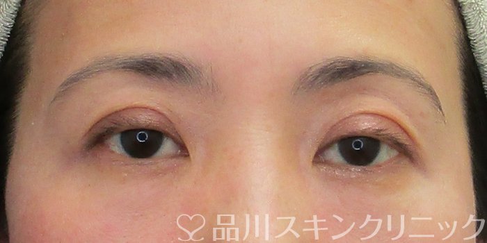 症例NO.74427のAFTER写真