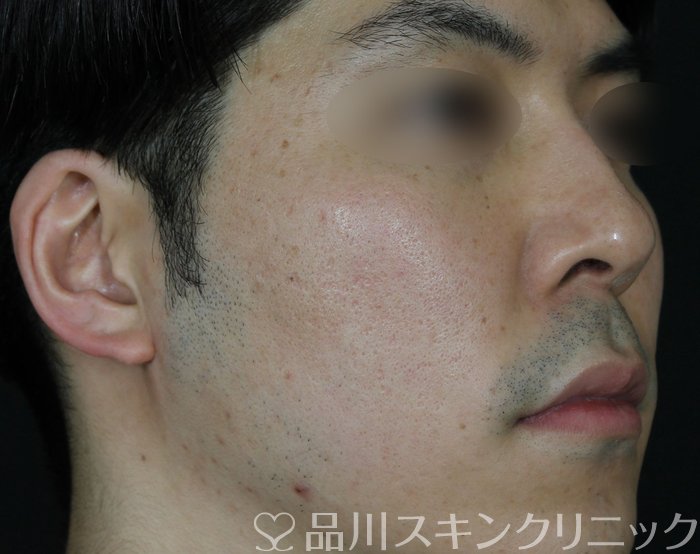 症例NO.69565のBEFORE写真