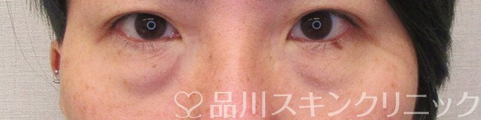 症例NO.71215のBEFORE写真