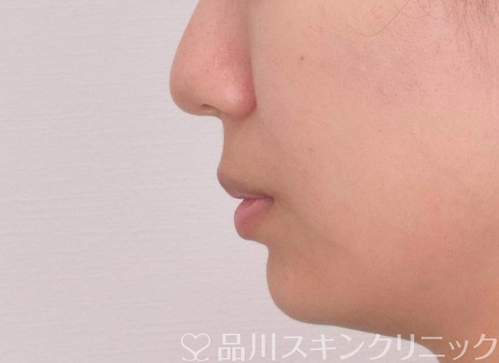 症例NO.67764のAFTER写真