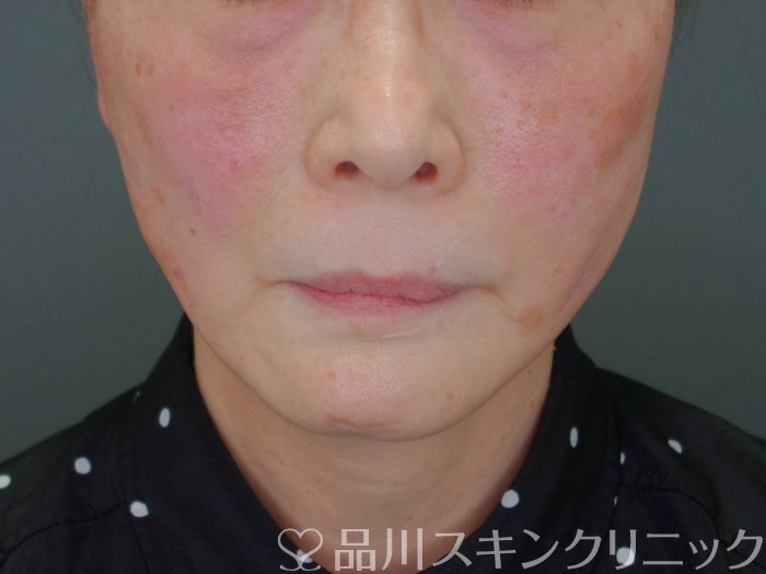 症例NO.73049のAFTER写真