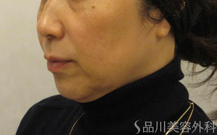 症例NO.72507のBEFORE写真