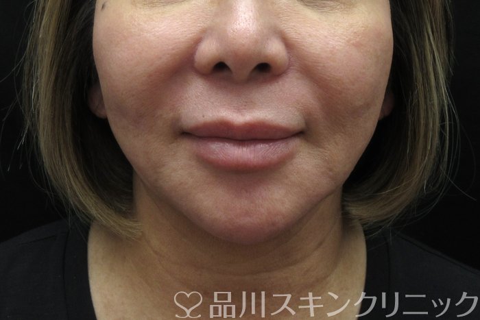 症例NO.74722のBEFORE写真